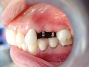 mini dental implants Colerain