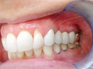 mini dental implants Colerain